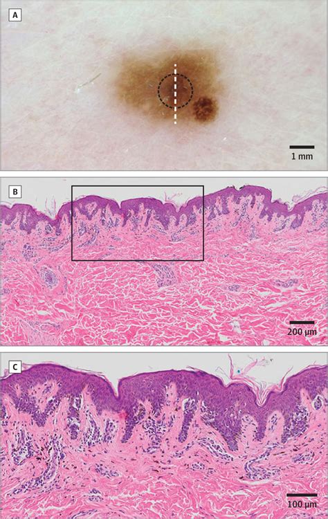 braf wild type melanoma